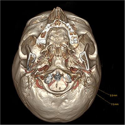 Narrow ovale foramina may be involved in the development of primary trigeminal neuralgia